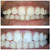 35% Teeth Whitening Gel Made in USA (8 Gels) 