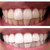 44%CP- Extreme Teeth Whitening Gel (8-Gels) SAVE 30% 