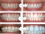 44% Teeth Whitening Gel (20-Gels)  