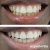 44% Teeth Whitening Gel USA Gel – 15-minutes  (8 Gels) | Expertwhite 