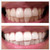 Expertwhite USA Teeth Whitening Strips – 12% Hydrogen Peroxide, Dentist-Grade (28 Strips, 14 Treatments)