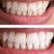 Expertwhite Advanced LED Peroxide Teeth Whitening Kit (Formulated USA)