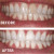 Expertwhite WhiteBomb Trays One Session. Seriously White.