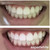 Teeth Whitening Gel 16 Carbamide Peroxide - Sensitive Teeth | Expertwhite 