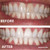 Teeth Whitening Gel 16 Carbamide Peroxide - Sensitive Teeth | Expertwhite 
