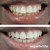 Teeth Whitening Gel 16 Carbamide Peroxide - Sensitive Teeth | Expertwhite 