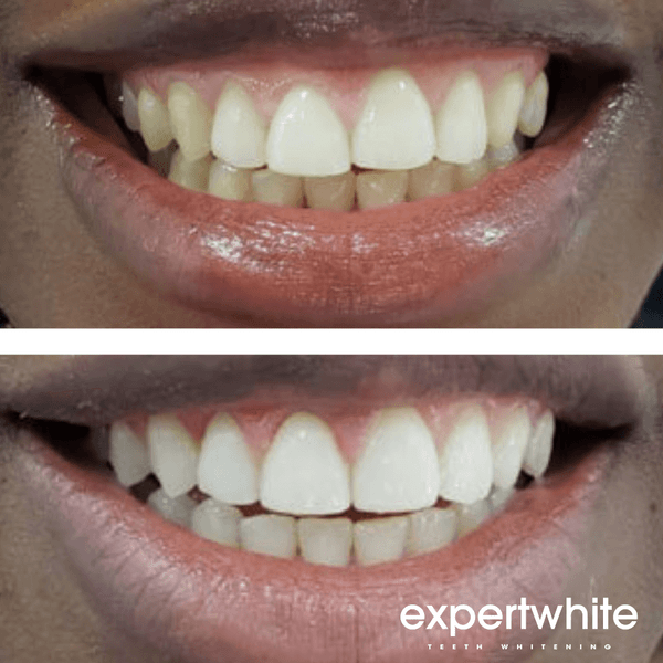 Expertwhite 16%CP -Gentle Teeth Whitening Gel (60-min/nite)