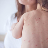 Chicken Pox Parties Chicken Pox Parties