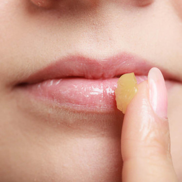 What to do when a cold sore strikes?