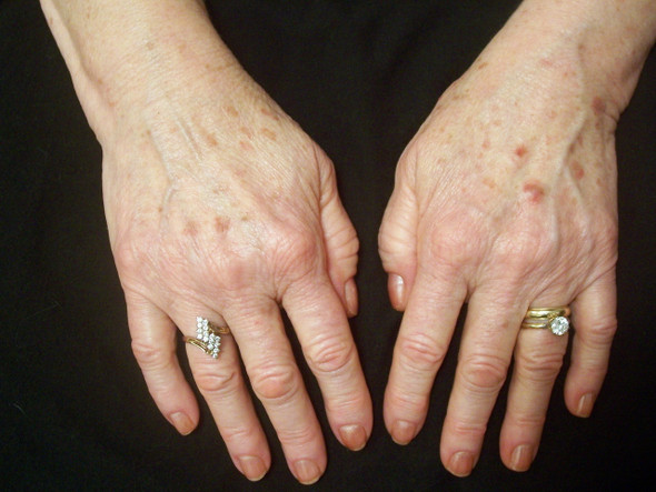 Perrin's Creme Complete Before Skin Problems Photo Perrin's Creme Complete Before Skin Problems Photo