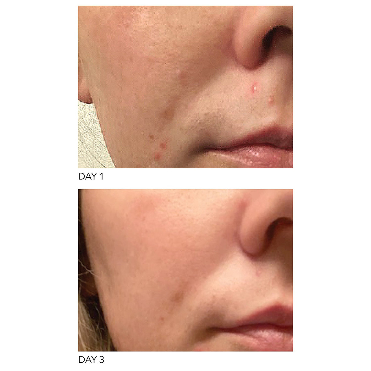 dr dennis gross blemish solution