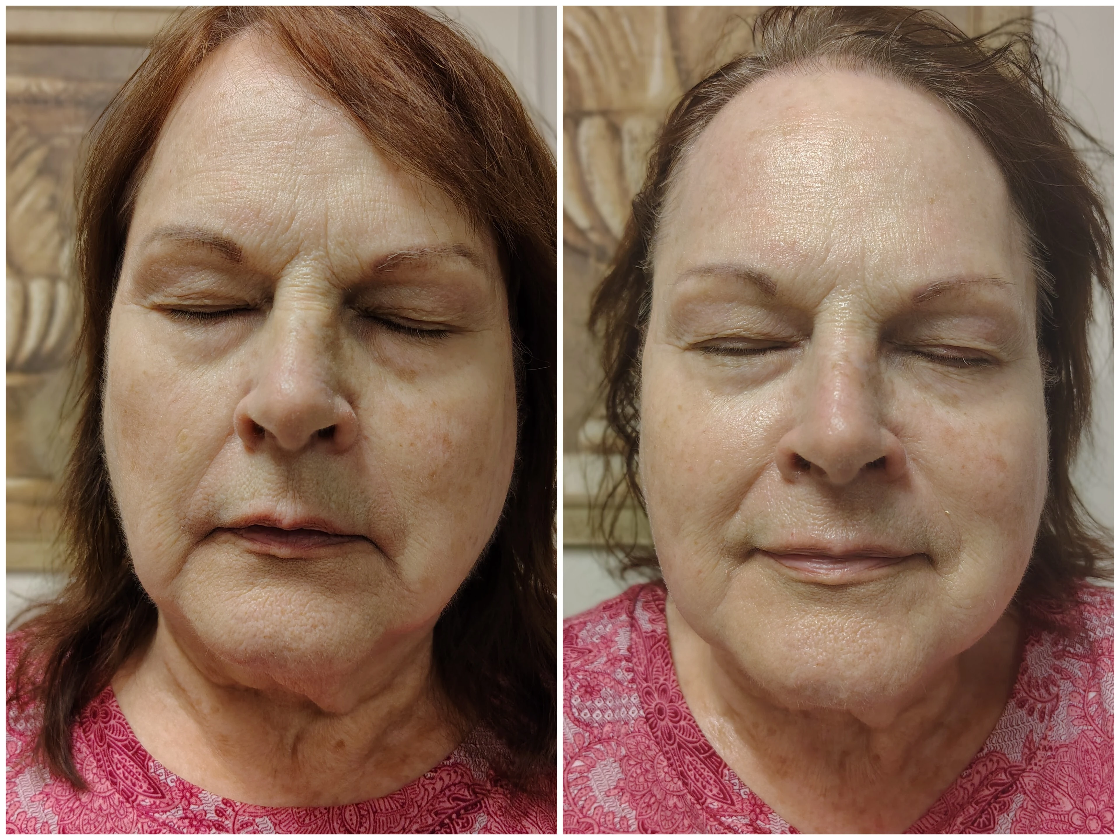 1 Uplifting Reviving Neveskin Facial 