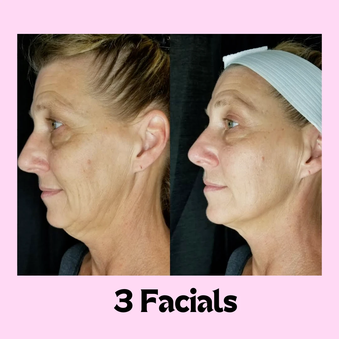 3 Facials before and after