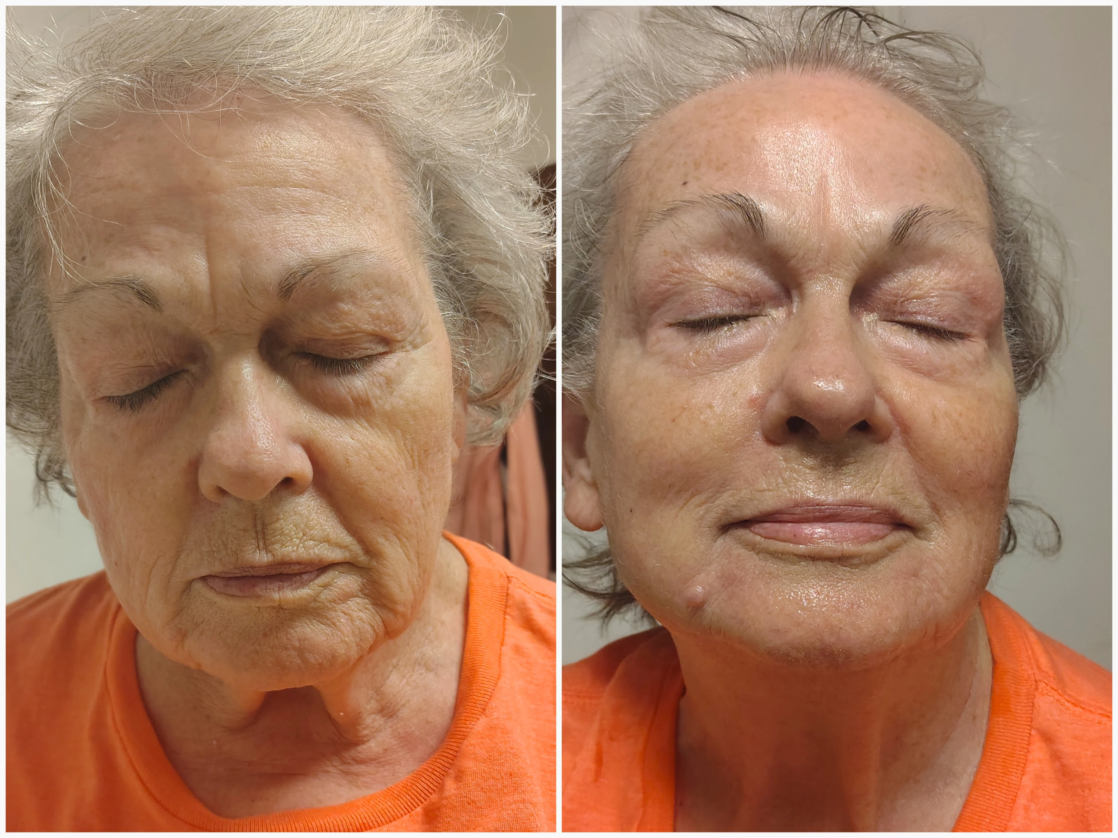 1 Neveskin Facelift facial