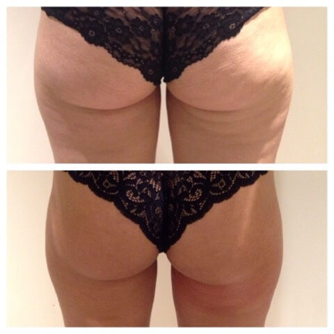 Buttlift