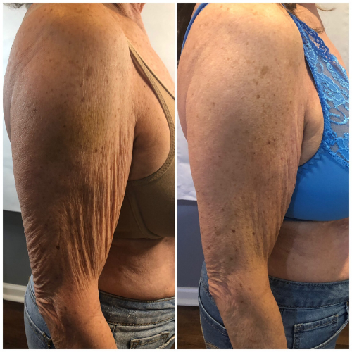 Tighten and Tone