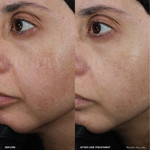 Ultra LumiBright Brightening Peel