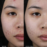 Clarifying Mandelic Peel