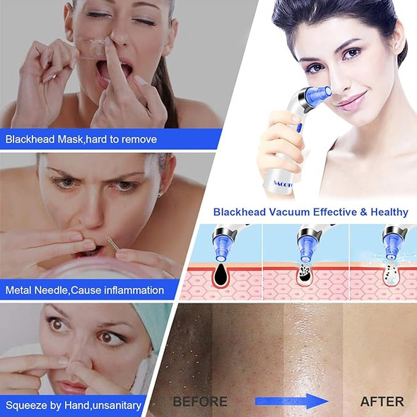 SACATO Blackhead Remover Pore Vacuum, Face Suction Pore Cleanser HTY-2 - BLUE