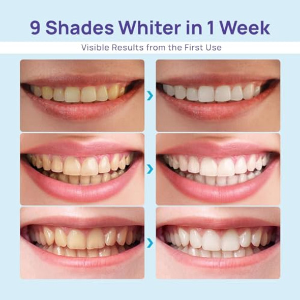 WHITEBITE PRO TEETH WHITENING KIT GELS WITHOUT SENSITIVITY (CRYSTAL MINT) WP02