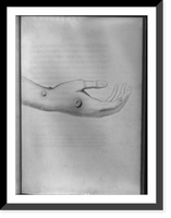 Hand of Gloucestershire milkmaid Sarah Nelmes showing cowpox blisters from which Edward Jenner developed smallpox vaccination technique, Historic Print