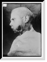 Historic Framed Print, Dum-Dum Wound man,  17-7/8" x 21-7/8"