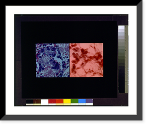 Visualization image for AIDS related pneumonia Classic, Antique Wall Art