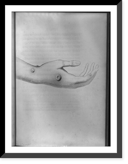 Hand of Gloucestershire milkmaid Sarah Nelmes showing cowpox blisters from which Edward Jenner developed smallpox vaccination technique, Historic Print