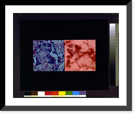 Visualization image for AIDS related pneumonia Classic, Antique Wall Art