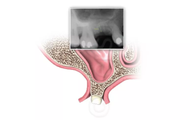 Crestal Sinus Lift Technique Skips the Lateral Window