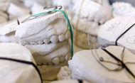 What Dental Implant Research Says About Bone Preservation Techniques