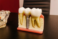 Dental Implant Stability Starts With How the Site Is Prepared