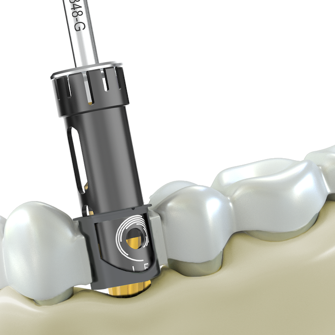 Guided Surgery