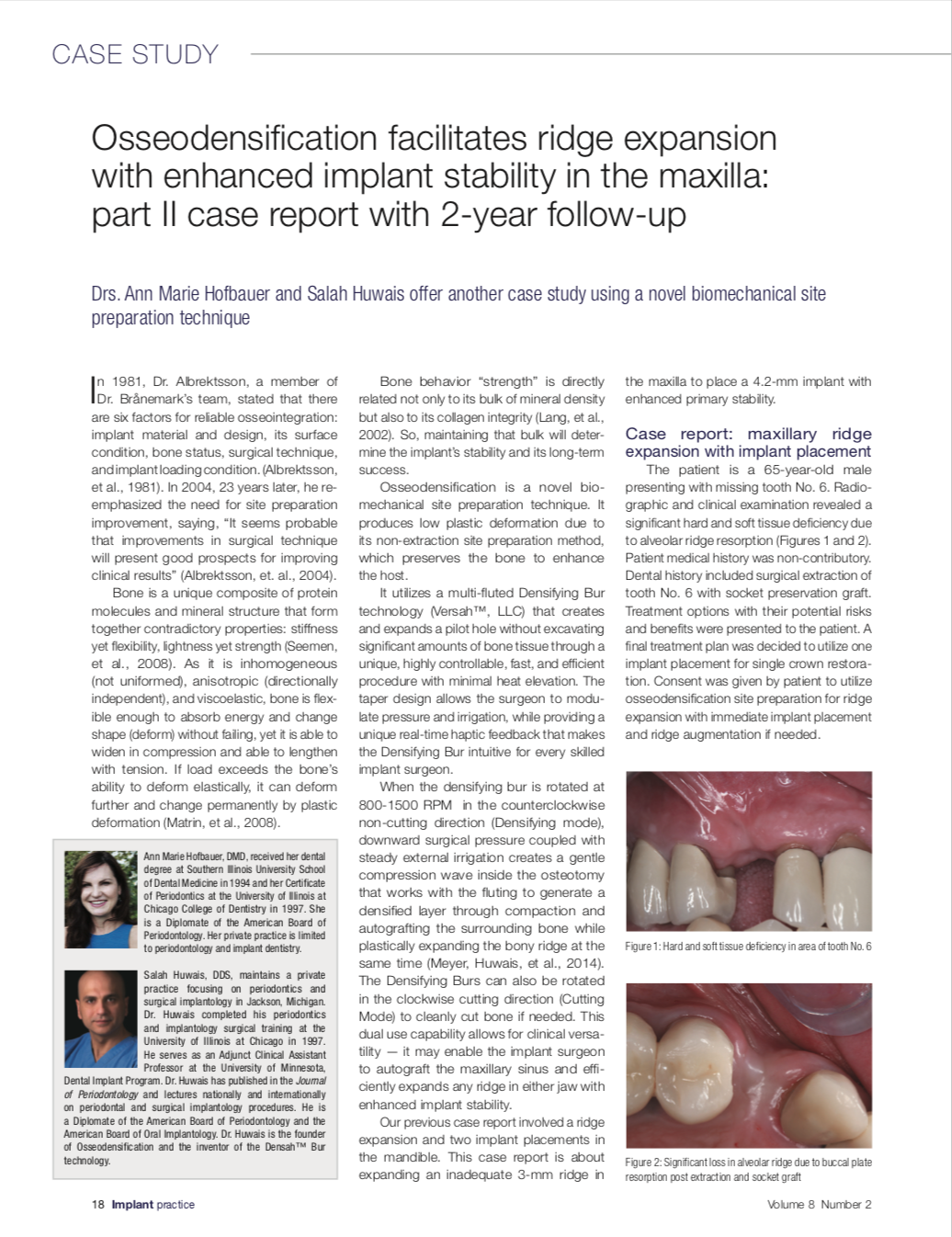 Osseodensification utilizing the Densah™ Bur technology produces stronger osteotomy for any implant. It preserves the bone to enhance the host. This allows for clinical versatility, which may facilitate enhanced implant stability and efficient expansion of any ridge in either jaw.