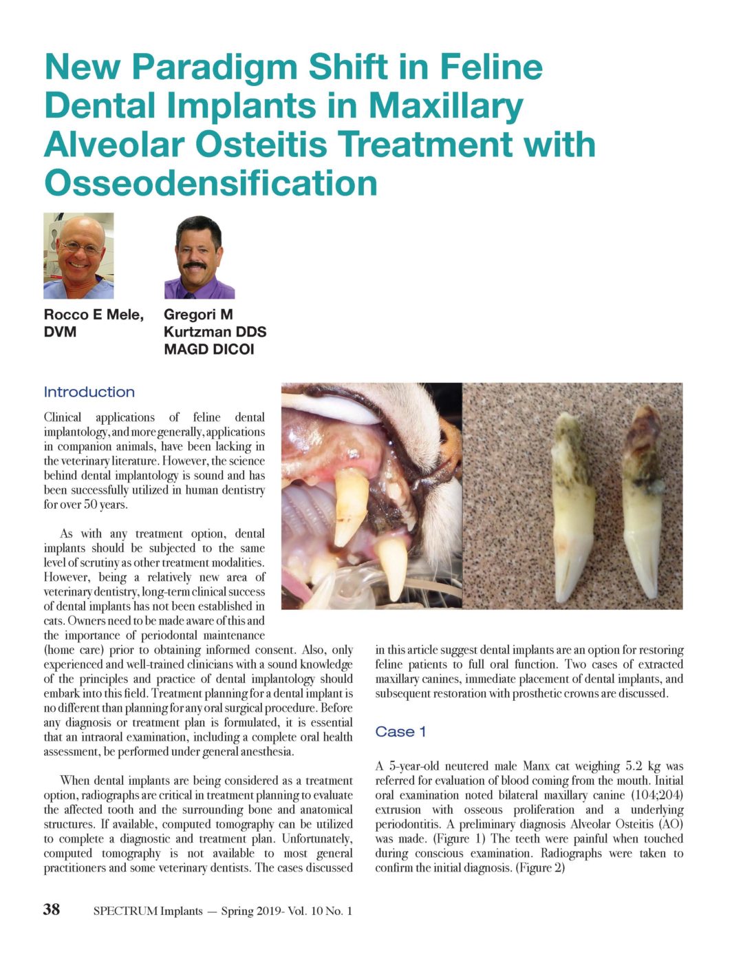 Dental implants were a viable long-term treatment option in the 2 cats described in this article. The best approach seems to be immediate implant placement at the time of extraction to maintain the surrounding osseous structures and prevent collapse of the labial buccal plate that may result when a delayed placement approach is undertaken. With careful treatment planning and informed owner consent, implants placed into the canine area to replace a fractured or badly damaged tooth can restore the feline to normal function. Thus far, the authors have placed 30 implants in 15 feline patients (14 of which have been restored), monitoring these cases up to a three year period and no integration failures have been observed to date. Long-term results have shown implants and crown restorations can be maintained without adverse periodontal sequela or crown fracture. Continued follow-up of these cases is ongoing.