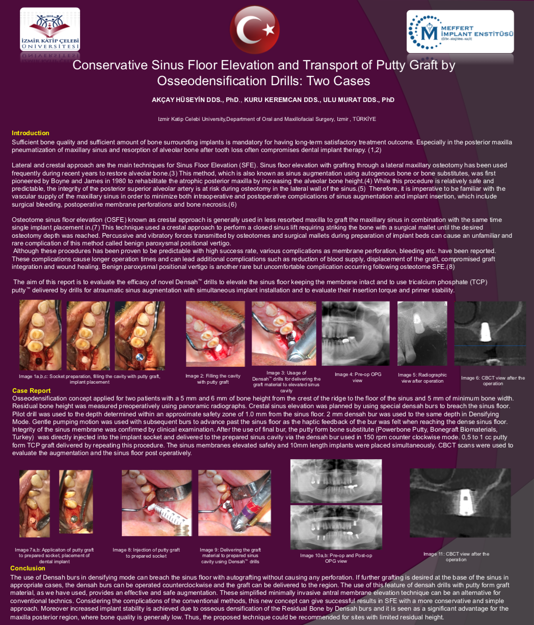 The use of Densah burs in densifying mode can breach the sinus floor with autografting without causing any perforation. If further grafting is desired at the base of the sinus in appropriate cases, the densah burs can be operated counterclockwise and the graft can be delivered to the region. The use of this feature of densah drills with putty form graft material, as we have used, provides an effective and safe augmentation. These simplified minimally invasive antral membrane elevation technique can be an alternative for conventional technics. Considering the complications of the conventional methods, this new concept can give successful results in SFE with a more conservative and simple approach. Moreover increased implant stability is achieved due to osseous densification of the Residual Bone by Densah burs and it is seen as a significant advantage for the maxilla posterior region, where bone quality is generally low. Thus, the proposed technique could be recommended for sites with limited residual height