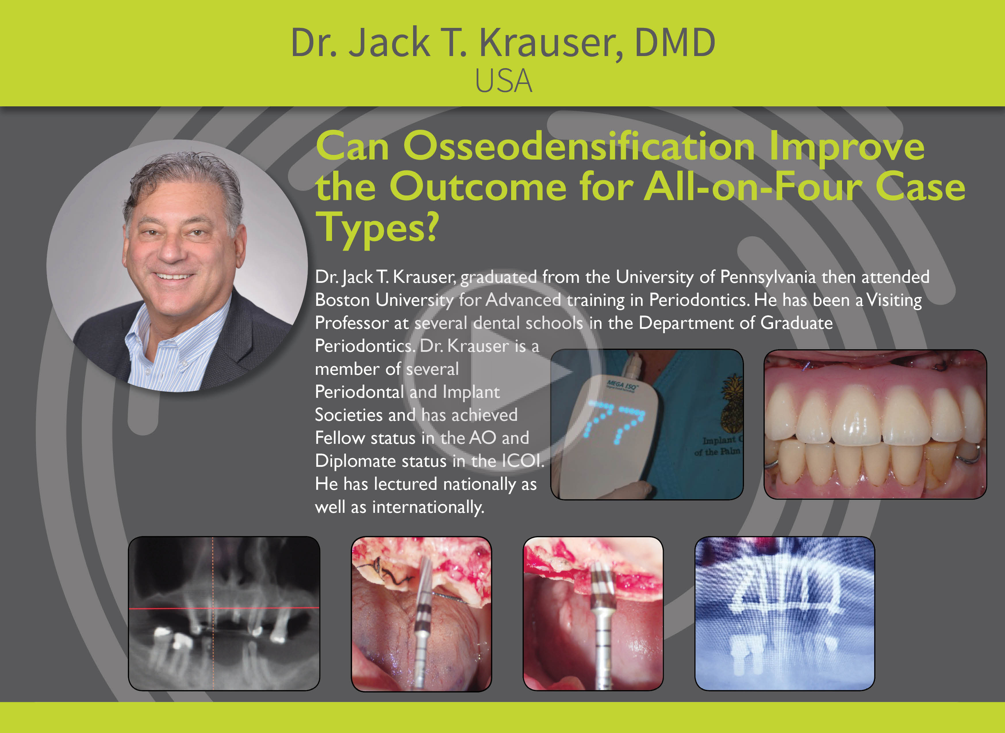 Can Osseodensification Improve the Outcome for All-On-Four Case Types?