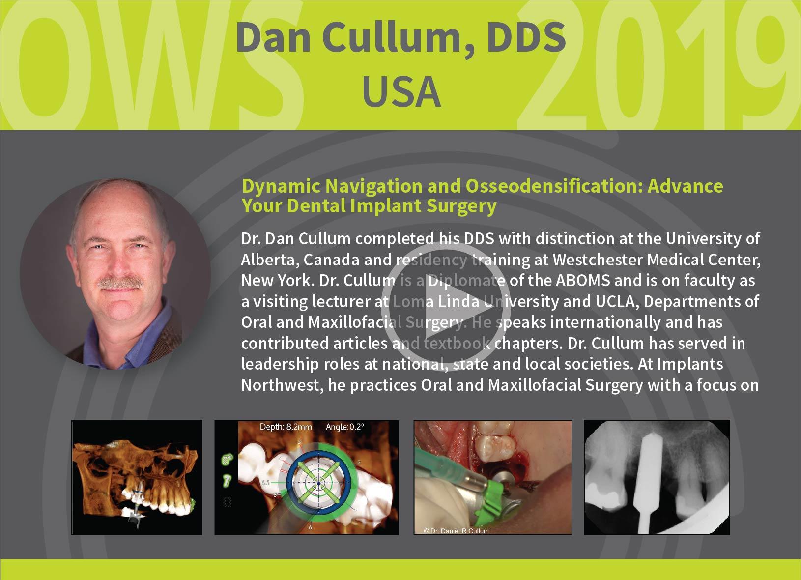 Dynamic Navigation and Osseodensification: Advance Your Dental Implant Surgery