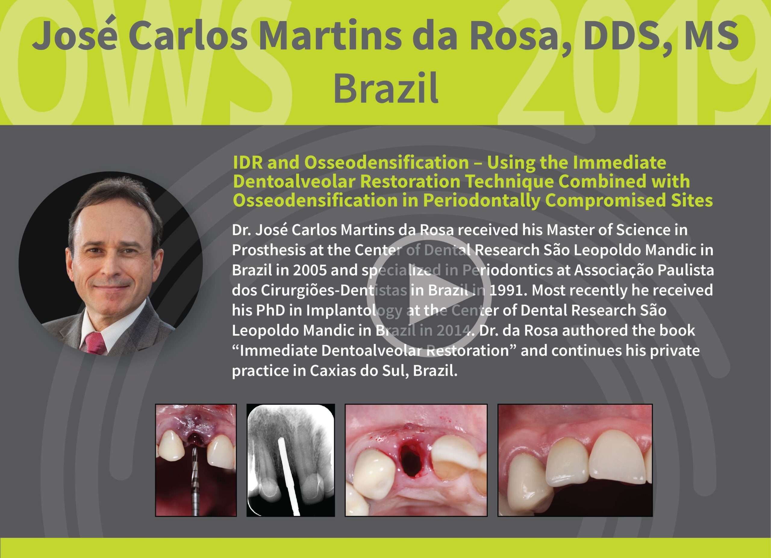 IDR and Osseodensification - Using the Immediate Dentoalveolar Restoration Technique Combined with Osseodensification in Periodontally Compromised Sites