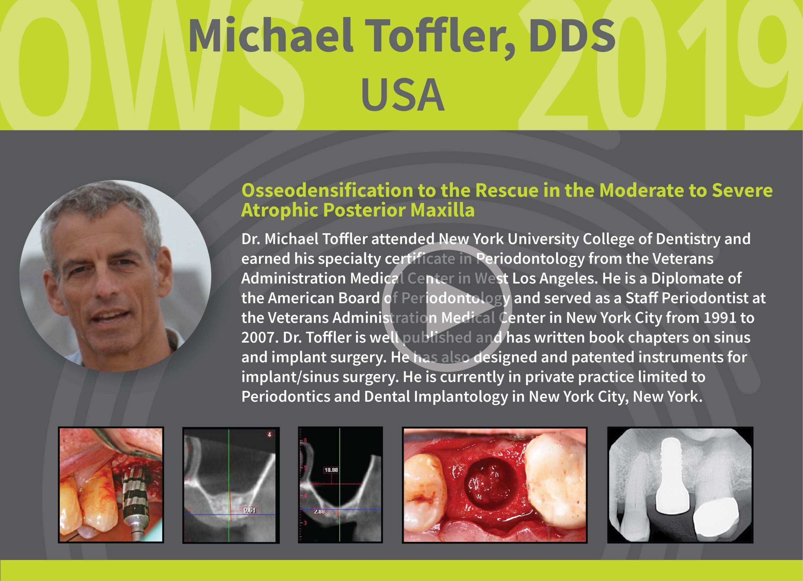 Osseodensification to the Rescue in the Moderate to Severe Atrophic Posterior Maxilla