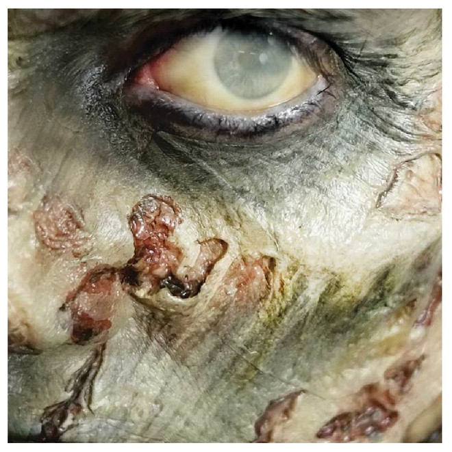 3D Zombie Cheekbones Prosthetic Transfer