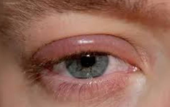 Understanding Allergic Reactions to Eyelash Adhesives