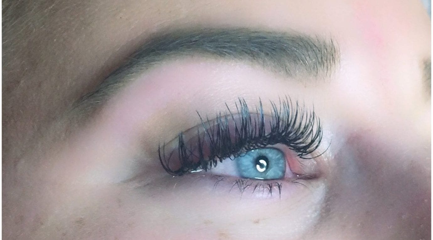 Blepharitis From Eyelash Extensions