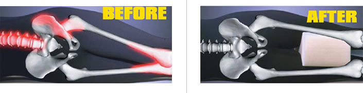 before-after-leg-pillow.jpg before-after-leg-pillow.jpg