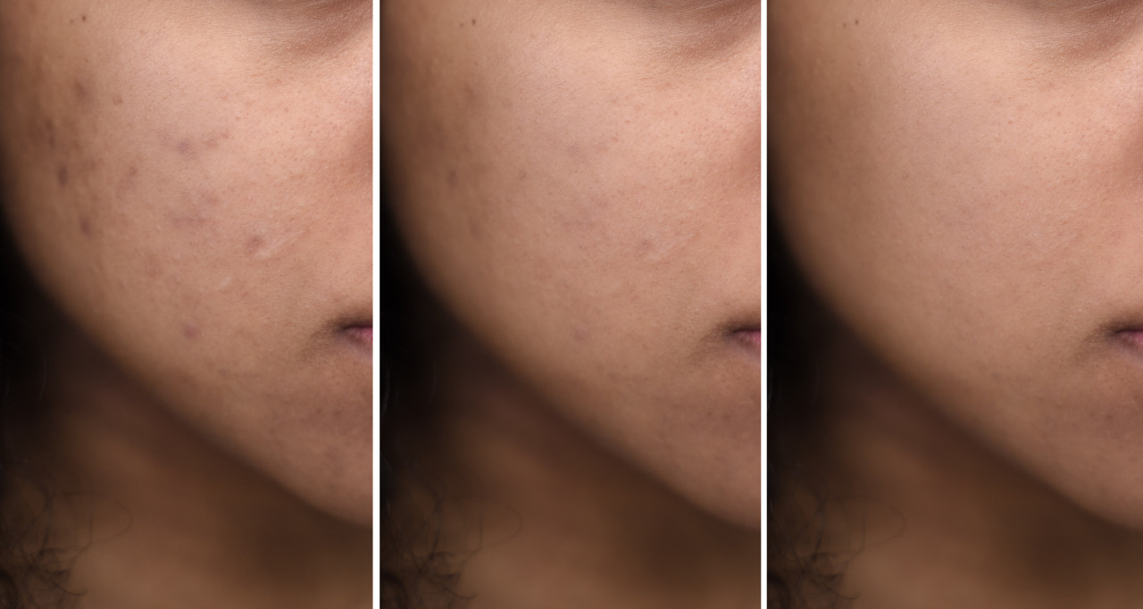 Hyaluronic Acid Serum For Wrinkles | Hydrating Serum With