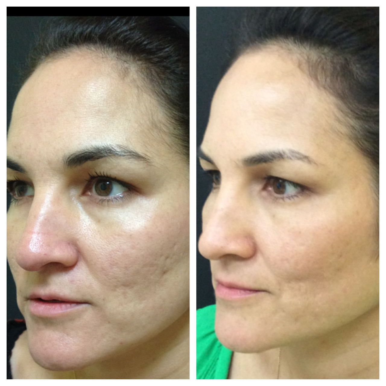 Vitamin C Serum For Hyperpigmentation | VersaBright Damage Control