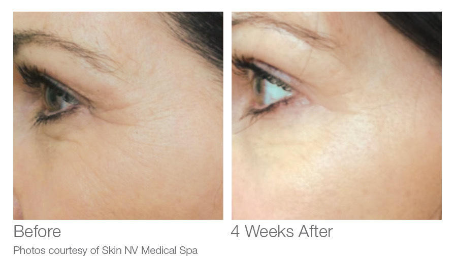 VersaLift® Eye Restore + Lifting Cream - PriyanaMD