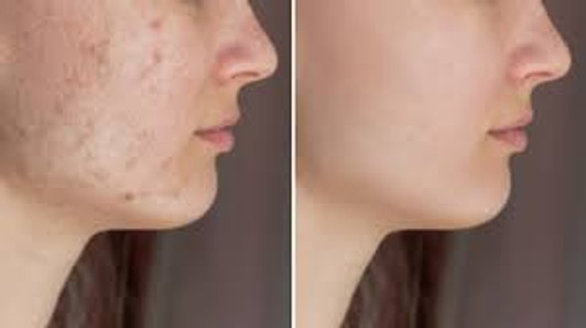 VersaPeel® AHA 25% + BHA 2% Exfoliating Gel Peel