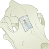 Placa en L reabsorbible, 6 orificios, 1 mm Placa en L reabsorbible, 6 orificios, 1 mm