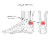 ACHILLES TENDONITIS CAUSES, SYMPTOMS, AND TREATMENT | BIOSKIN BRACING